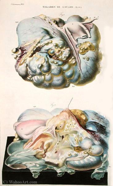Wikioo.org - The Encyclopedia of Fine Arts - Painting, Artwork by Antoine Chazal - Diseases of the Ovaries, from 'Anatomie Pathologique du Corps Humain'