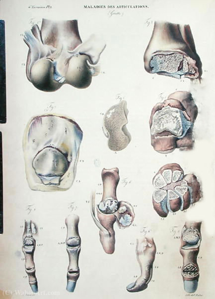 Wikioo.org - The Encyclopedia of Fine Arts - Painting, Artwork by Antoine Chazal - Pathological human body