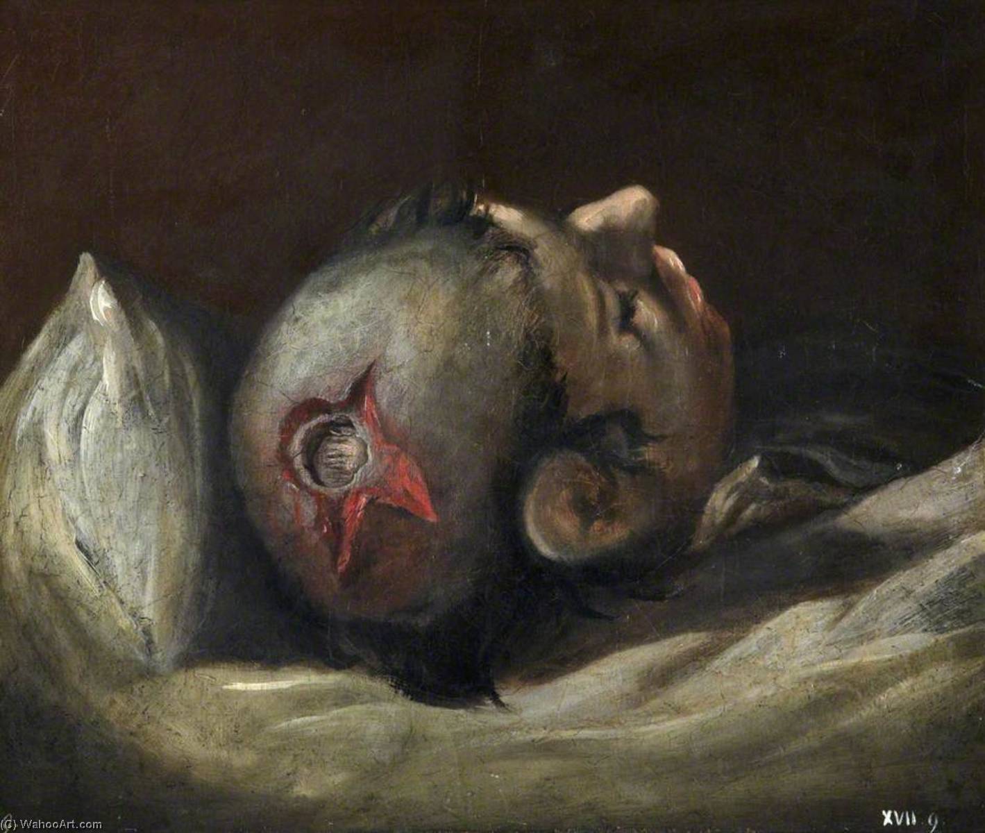 Wikioo.org - The Encyclopedia of Fine Arts - Painting, Artwork by Charles Bell - The Wounded following the Battle of Corunna Musket Ball Wound of Skull