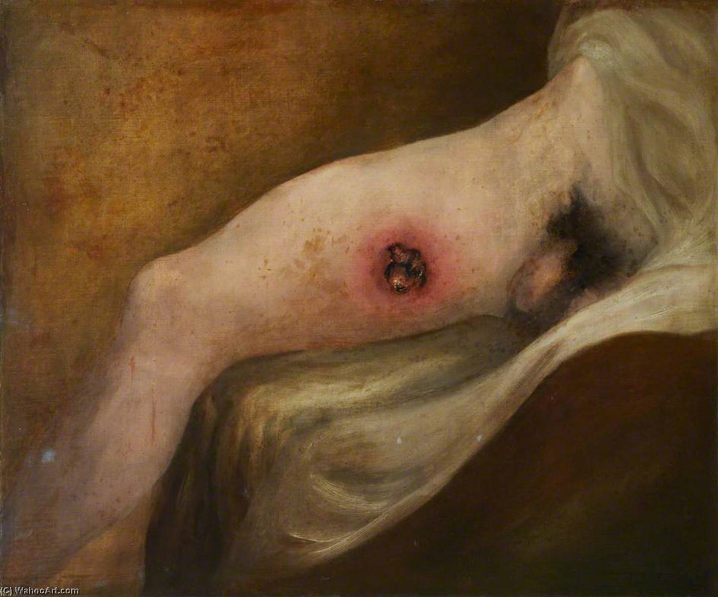 Wikioo.org - The Encyclopedia of Fine Arts - Painting, Artwork by Charles Bell - The Wounded following the Battle of Corunna Gunshot Wound of Thigh