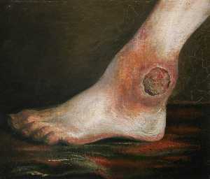 The Wounded following the Battle of Corunna Gunshot Wound of Ankle Joint